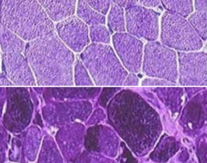 Muscle biopsy showing normal glycogen storage (top) and from a horse with a GYS1 gene mutation (bottom). The dark areas from the afflicted tissue sample show the excess glycogen stored in the muscle cells :: Photo © www.pssmawareness.com)