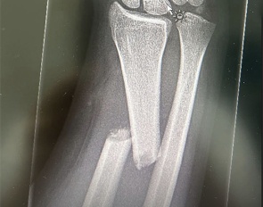 Olivia Vliek fractured her arm and wrist in a car accident. Get well soon!