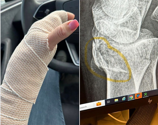 Katherine Bateson-Chandler broke her arm. Get well soon !